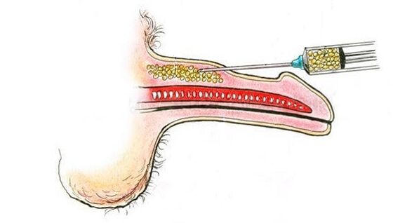 A hialuronsav injekciója a tag hordójába annak növelése érdekében
